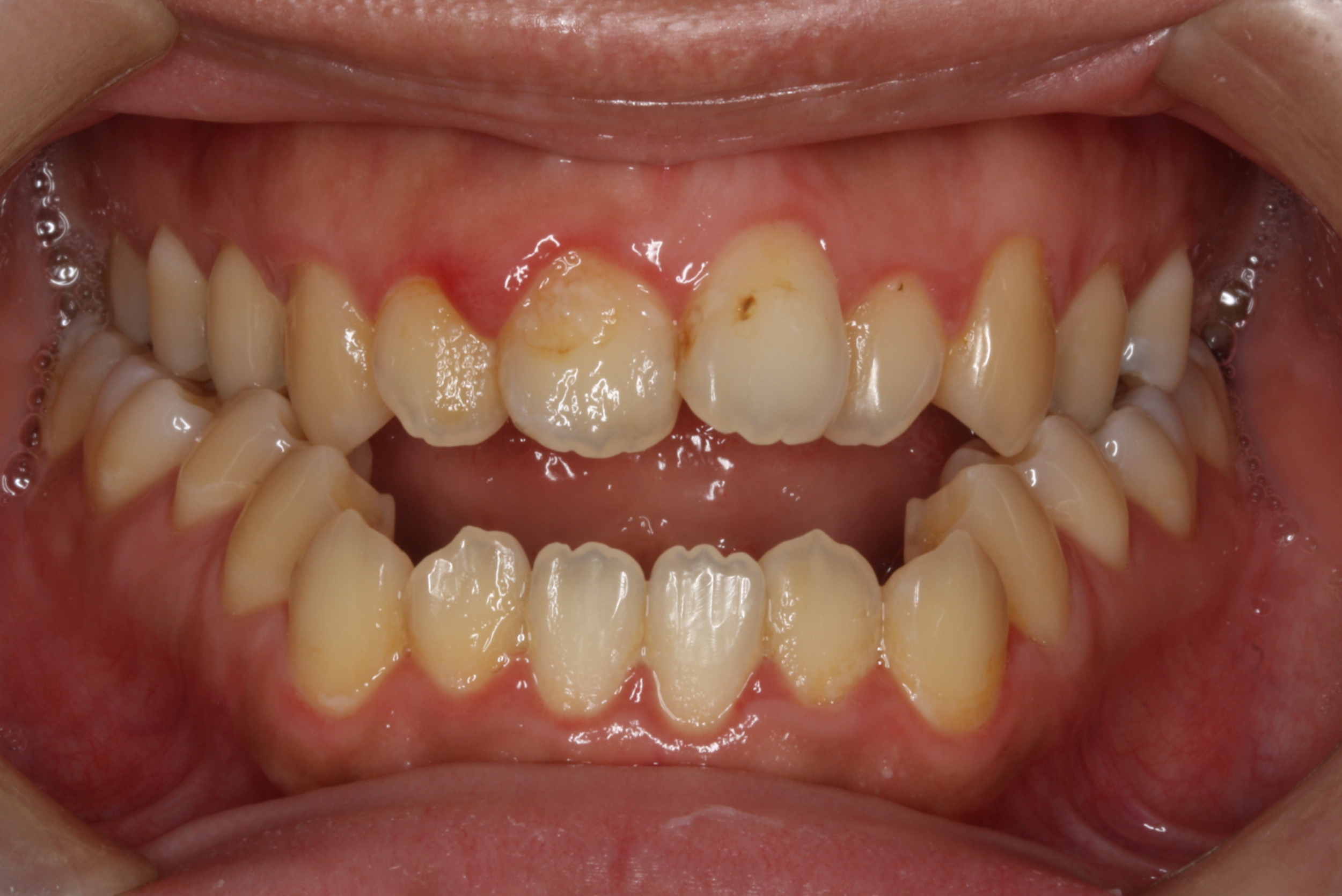 骨性暴牙矯正的原理是什麼？ - 上誠牙醫